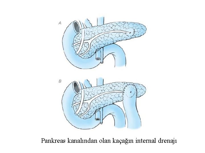 Pankreas kanalından olan kaçağın internal drenajı 