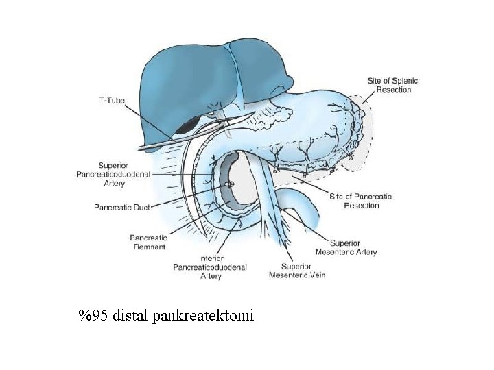 %95 distal pankreatektomi 