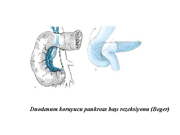 Duodenum koruyucu pankreas başı rezeksiyonu (Beger) 