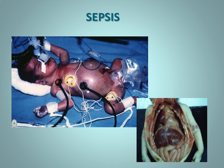 SEPSIS 