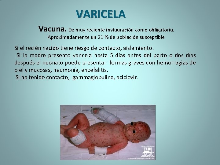 VARICELA Vacuna. De muy reciente instauración como obligatoria. Aproximadamente un 20 % de población