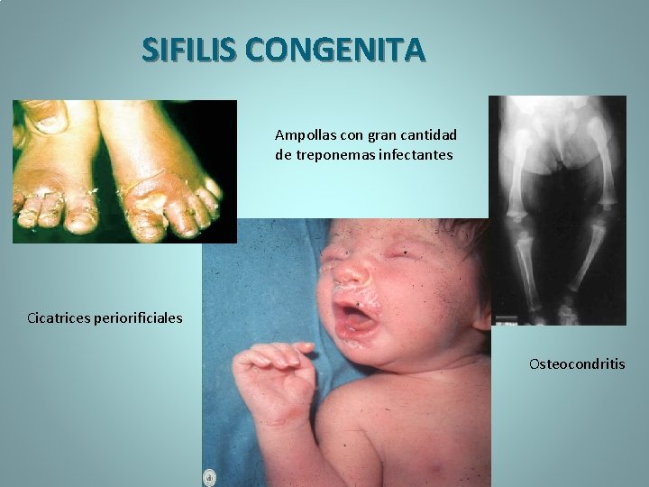 SIFILIS CONGENITA Ampollas con gran cantidad de treponemas infectantes Cicatrices periorificiales Osteocondritis 