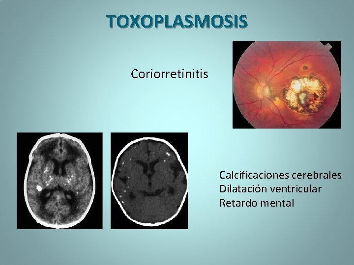 TOXOPLASMOSIS Coriorretinitis Calcificaciones cerebrales Dilatación ventricular Retardo mental 