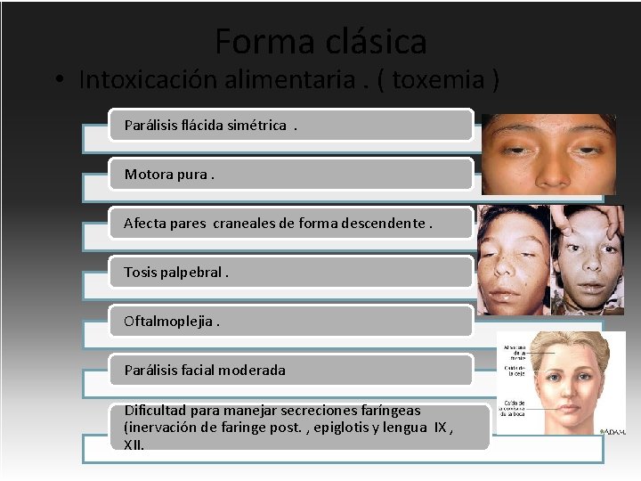 Forma clásica • Intoxicación alimentaria. ( toxemia ) Parálisis flácida simétrica. Motora pura. Afecta