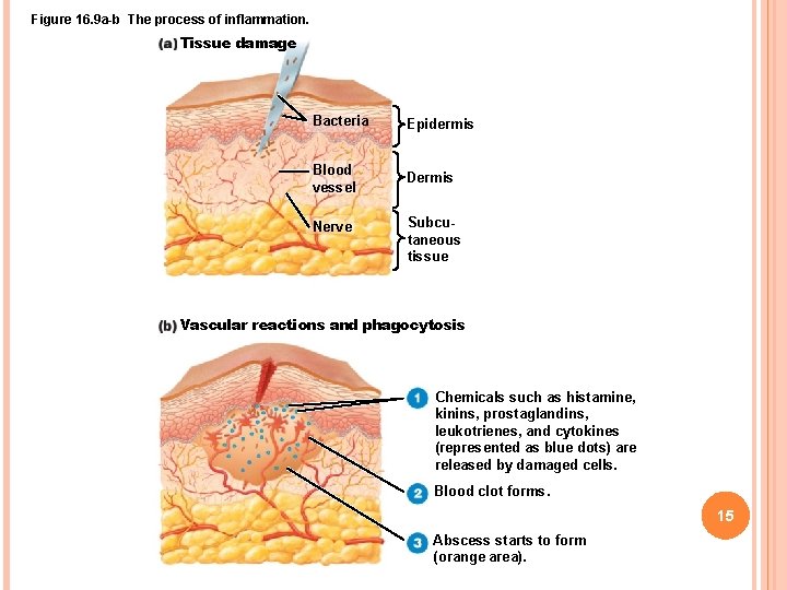 Figure 16. 9 a-b The process of inflammation. Tissue damage Bacteria Epidermis Blood vessel