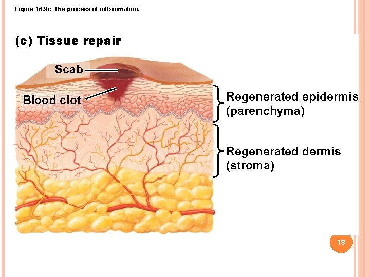 Figure 16. 9 c The process of inflammation. (c) Tissue repair Scab Blood clot