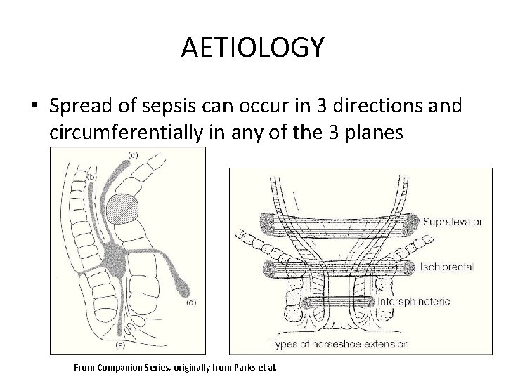 AETIOLOGY • Spread of sepsis can occur in 3 directions and circumferentially in any