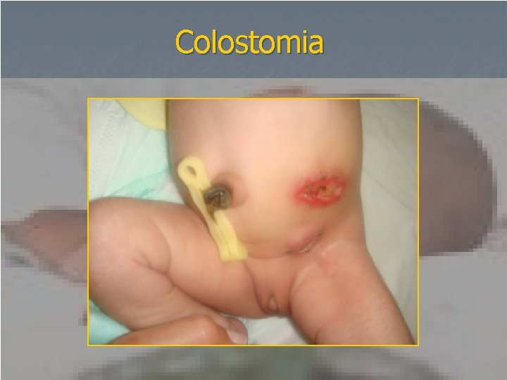 Colostomia 