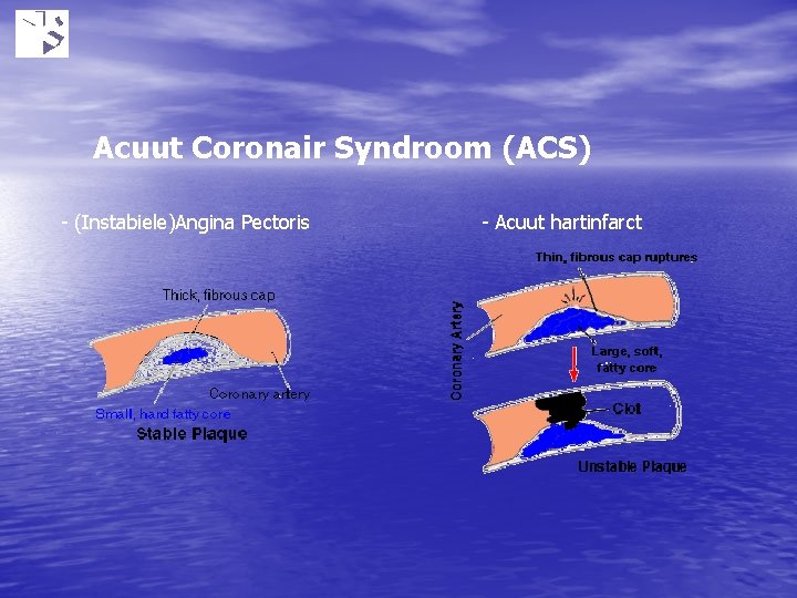 Acuut Coronair Syndroom (ACS) - (Instabiele)Angina Pectoris - Acuut hartinfarct 