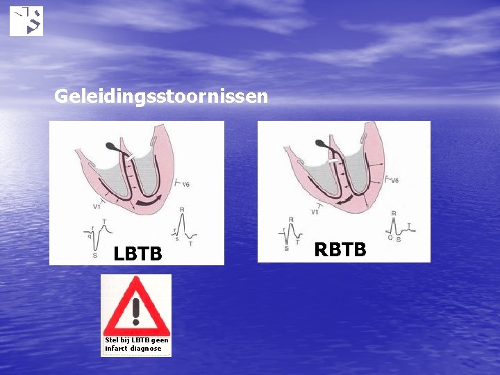 Geleidingsstoornissen LBTB Stel bij LBTB geen infarct diagnose RBTB 