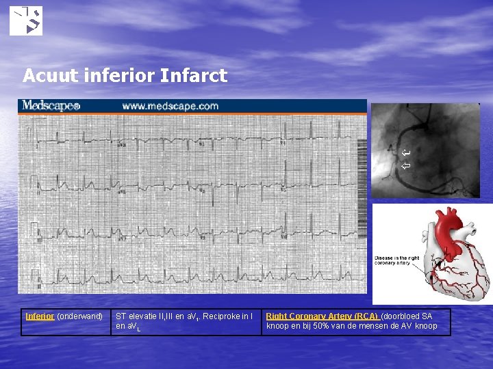 Acuut inferior Infarct Inferior (onderwand) ST elevatie II, III en a. Vf. Reciproke in