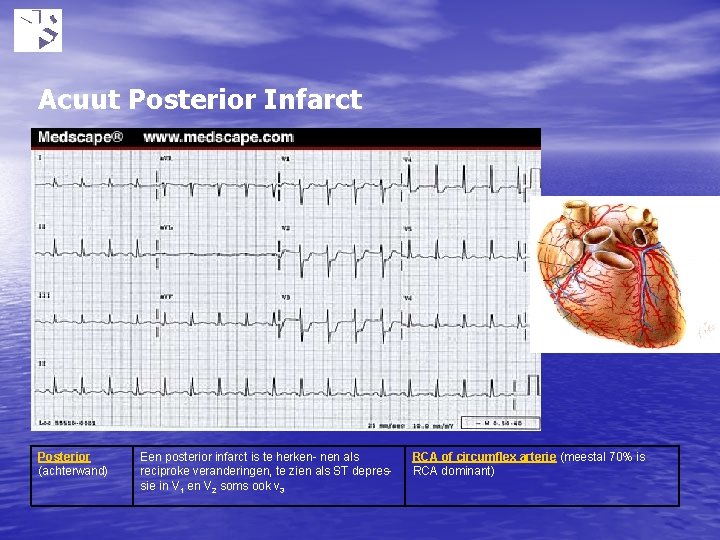 Acuut Posterior Infarct Posterior (achterwand) Een posterior infarct is te herken- nen als reciproke