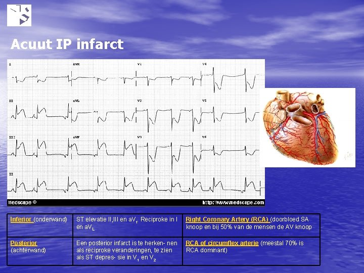 Acuut IP infarct Inferior (onderwand) ST elevatie II, III en a. Vf. Reciproke in