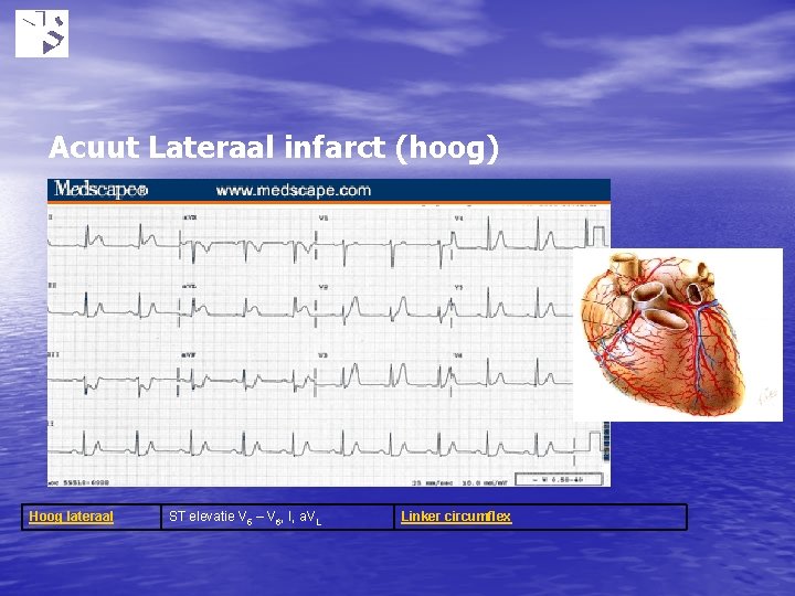 Acuut Lateraal infarct (hoog) Hoog lateraal ST elevatie V 5 – V 6, I,