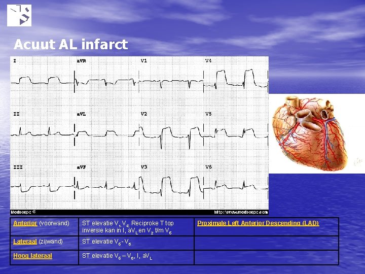 Acuut AL infarct Anterior (voorwand) ST elevatie V 1 -V 4. Reciproke T top