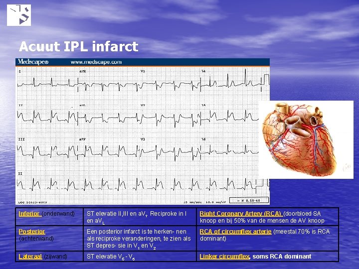 Acuut IPL infarct Inferior (onderwand) ST elevatie II, III en a. Vf. Reciproke in