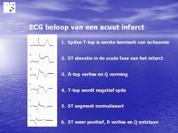 ECG beloop van een acuut infarct 1. Spitse T-top is eerste kenmerk van ischeamie