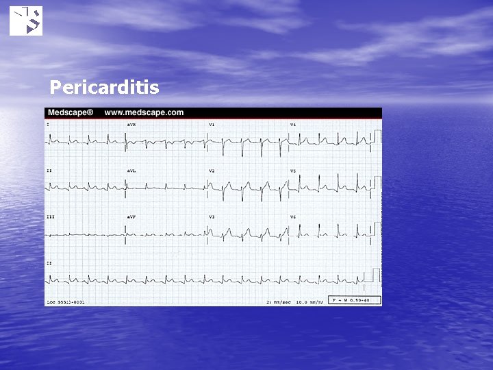 Pericarditis 