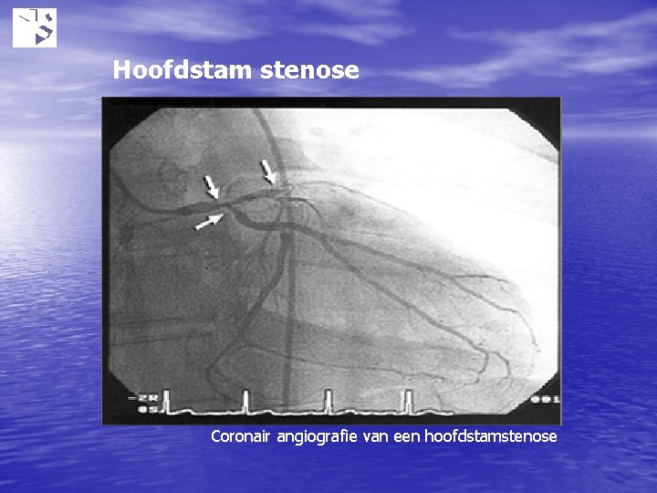 Hoofdstam stenose Coronair angiografie van een hoofdstamstenose 