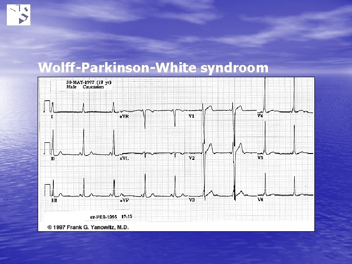 Wolff-Parkinson-White syndroom 