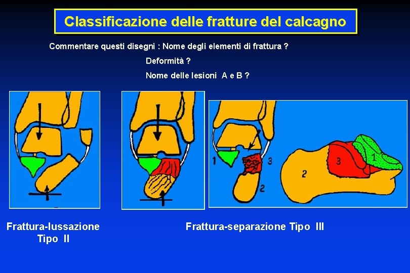 Classificazione delle fratture del calcagno Commentare questi disegni : Nome degli elementi di frattura