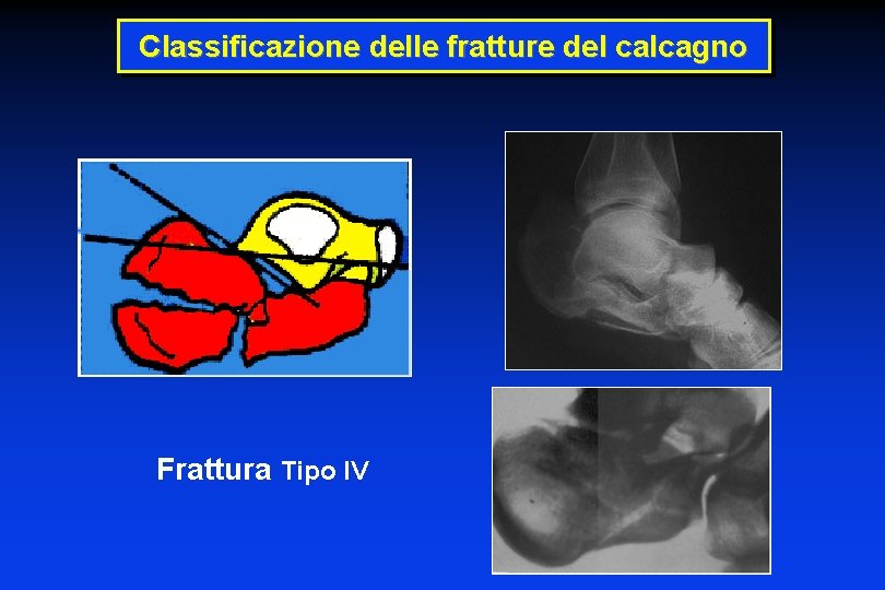 Classificazione delle fratture del calcagno Frattura Tipo IV 