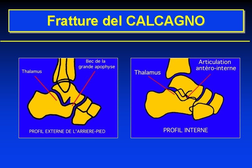 Fratture del CALCAGNO 