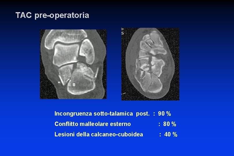 TAC pre-operatoria II B Incongruenza sotto-talamica post. : 90 % Conflitto malleolare esterno :