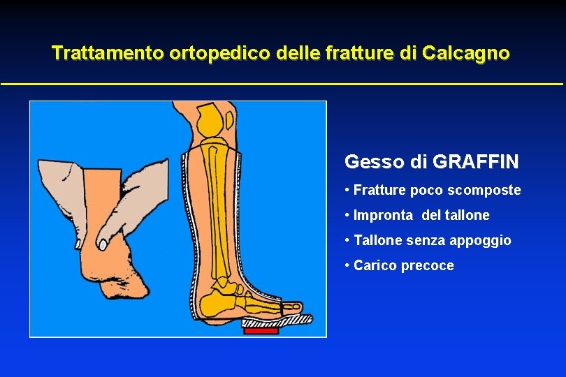 Trattamento ortopedico delle fratture di Calcagno Gesso di GRAFFIN • Fratture poco scomposte •