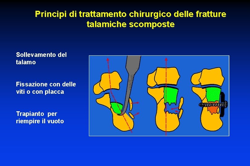 Principi di trattamento chirurgico delle fratture talamiche scomposte Sollevamento del talamo Fissazione con delle