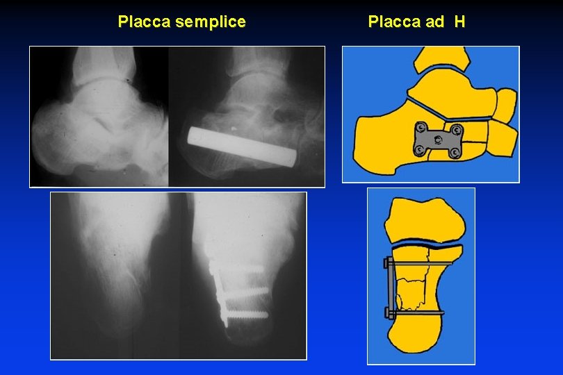 Placca semplice Placca ad H 