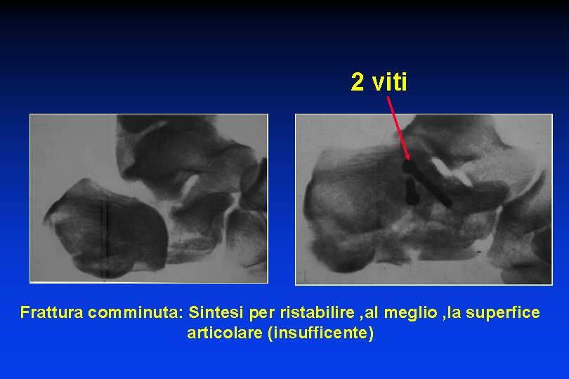 2 viti Frattura comminuta: Sintesi per ristabilire , al meglio , la superfice articolare