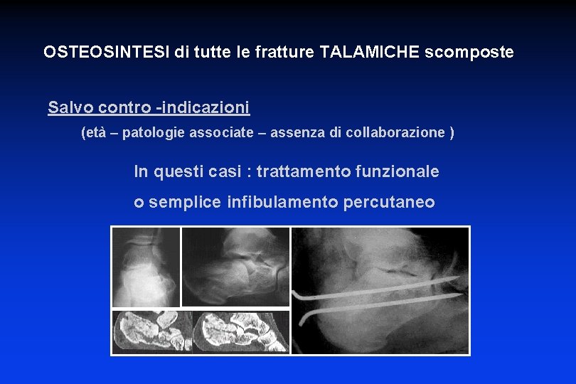 OSTEOSINTESI di tutte le fratture TALAMICHE scomposte Salvo contro -indicazioni (età – patologie associate