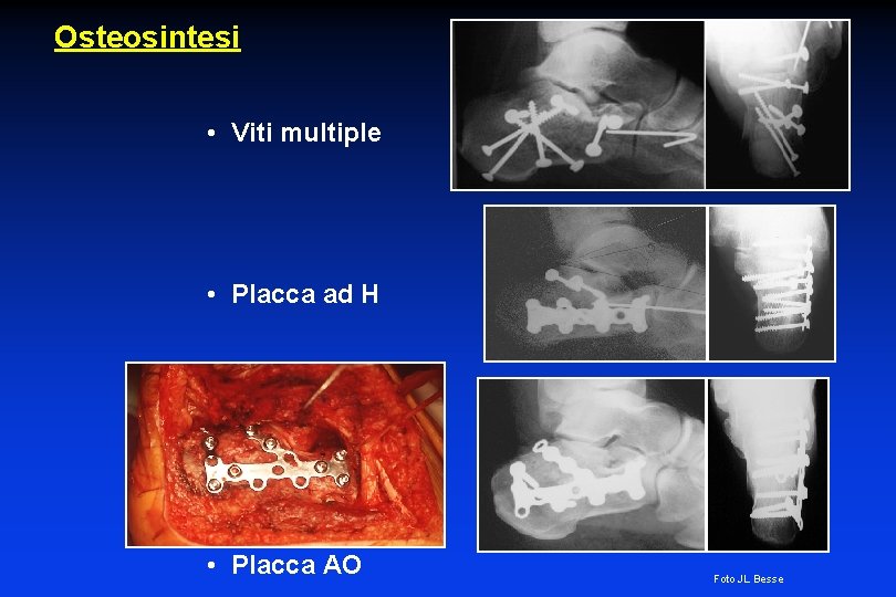 Osteosintesi • Viti multiple • Placca ad H • Placca AO Foto JL Besse