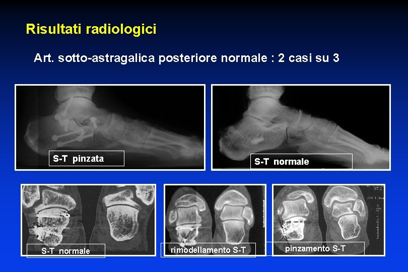 Risultati radiologici Art. sotto-astragalica posteriore normale : 2 casi su 3 S-T pinzata S-T