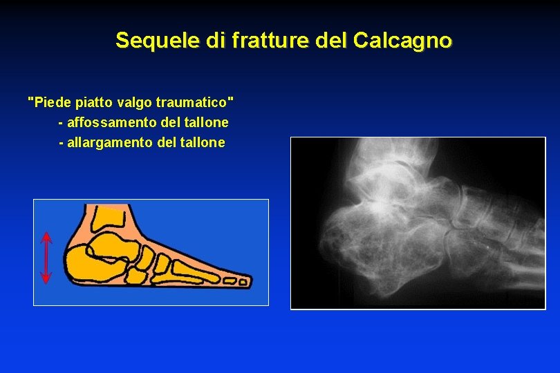 Sequele di fratture del Calcagno "Piede piatto valgo traumatico" - affossamento del tallone -