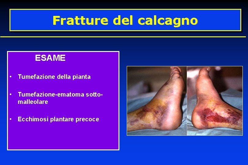 Fratture del calcagno ESAME • Tumefazione della pianta • Tumefazione-ematoma sottomalleolare • Ecchimosi plantare