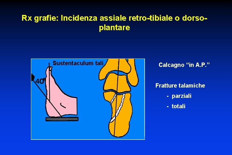 Rx grafie: Incidenza assiale retro-tibiale o dorsoplantare Sustentaculum tali Calcagno “in A. P. ”