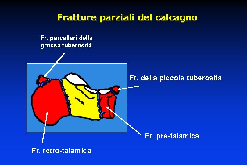 Fratture parziali del calcagno Fr. parcellari della grossa tuberosità Fr. della piccola tuberosità Fr.