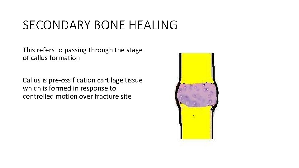 SECONDARY BONE HEALING This refers to passing through the stage of callus formation Callus SECONDARY BONE HEALING This refers to passing through the stage of callus formation Callus