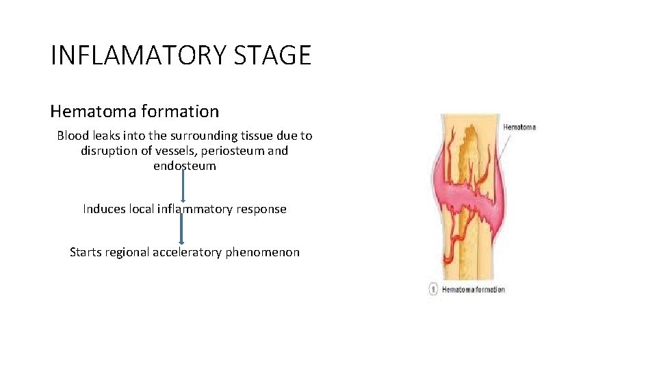 INFLAMATORY STAGE Hematoma formation Blood leaks into the surrounding tissue due to disruption of INFLAMATORY STAGE Hematoma formation Blood leaks into the surrounding tissue due to disruption of