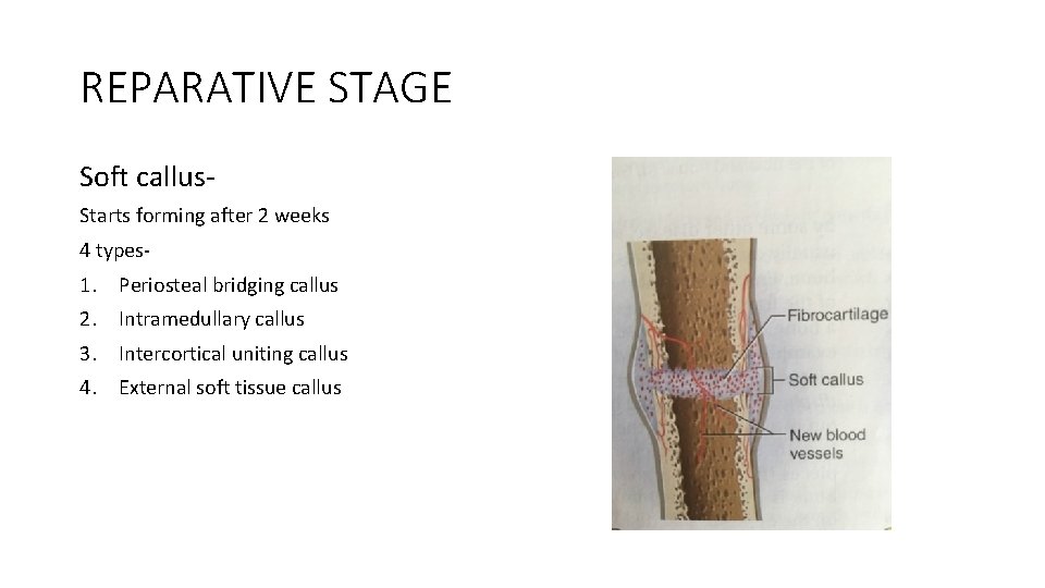 REPARATIVE STAGE Soft callus. Starts forming after 2 weeks 4 types- 1. Periosteal bridging REPARATIVE STAGE Soft callus. Starts forming after 2 weeks 4 types- 1. Periosteal bridging