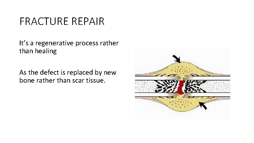 FRACTURE REPAIR It’s a regenerative process rather than healing As the defect is replaced FRACTURE REPAIR It’s a regenerative process rather than healing As the defect is replaced