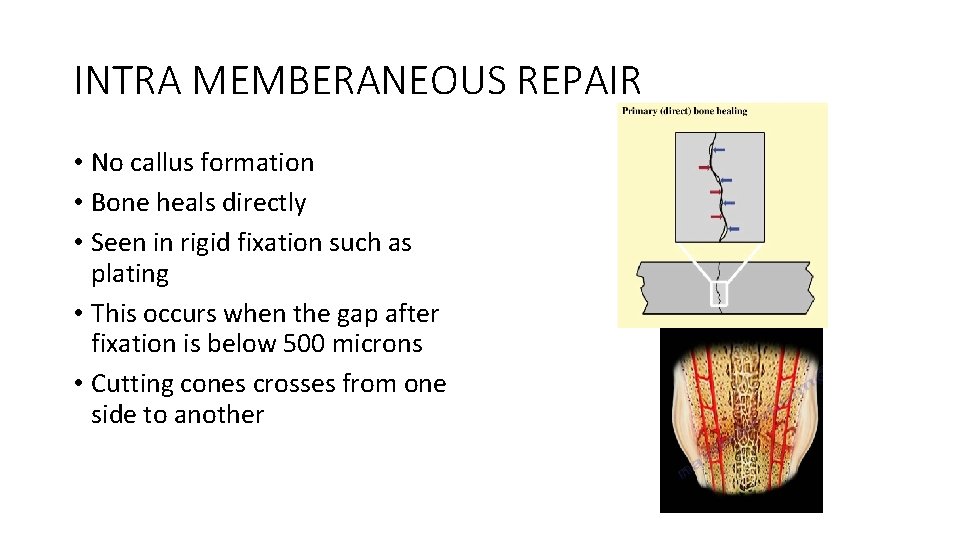 INTRA MEMBERANEOUS REPAIR • No callus formation • Bone heals directly • Seen in INTRA MEMBERANEOUS REPAIR • No callus formation • Bone heals directly • Seen in