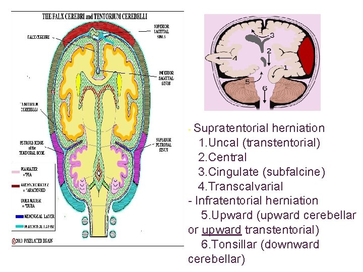 - Supratentorial herniation 1. Uncal (transtentorial) 2. Central 3. Cingulate (subfalcine) 4. Transcalvarial -