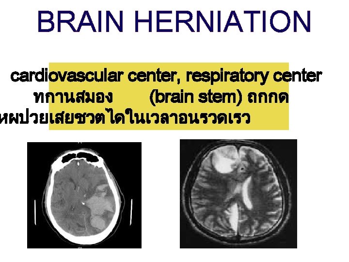 BRAIN HERNIATION cardiovascular center, respiratory center ทกานสมอง (brain stem) ถกกด หผปวยเสยชวตไดในเวลาอนรวดเรว 