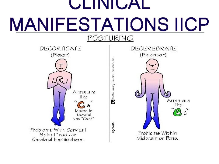 CLINICAL MANIFESTATIONS IICP 