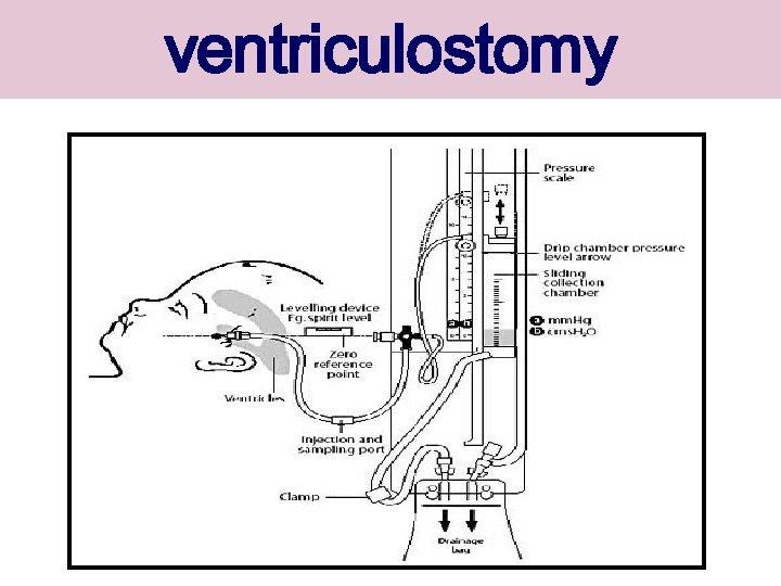 ventriculostomy 