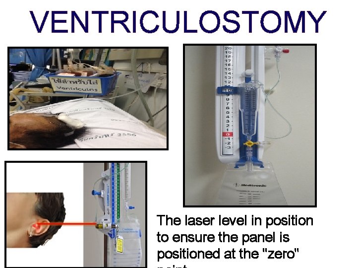 VENTRICULOSTOMY The laser level in position to ensure the panel is positioned at the