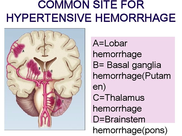 COMMON SITE FOR HYPERTENSIVE HEMORRHAGE A=Lobar hemorrhage B= Basal ganglia hemorrhage(Putam en) C=Thalamus hemorrhage